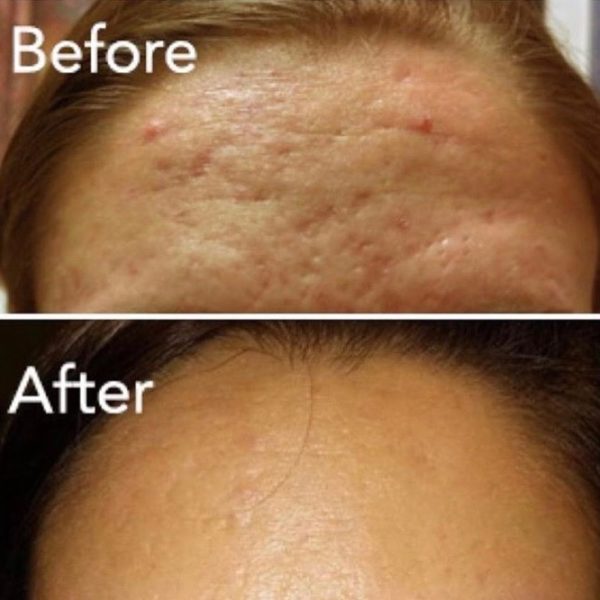 Vivace™ Microneedling RF Palm Beach Gardens, Port St. Lucie, and Jupiter FL