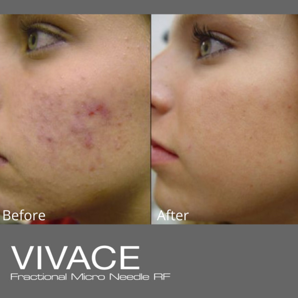 vivace before and after